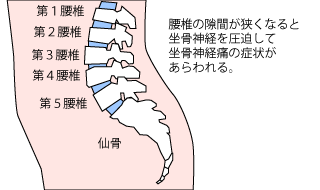坐骨神経痛の図
